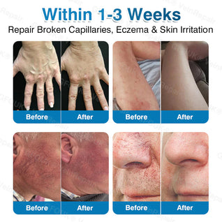 PatchRoll - Microneedling Patch Roll